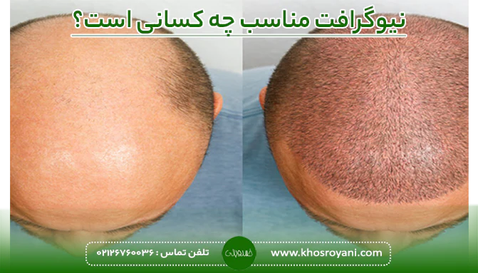نیوگرافت مناسب چه کسانی است
