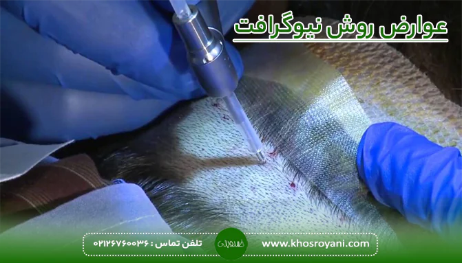 عوارض روش نیوگرافت 