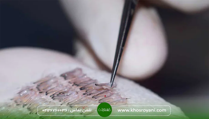 کاشت مو به روش FCI