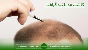 کاشت مو نیوگرافت