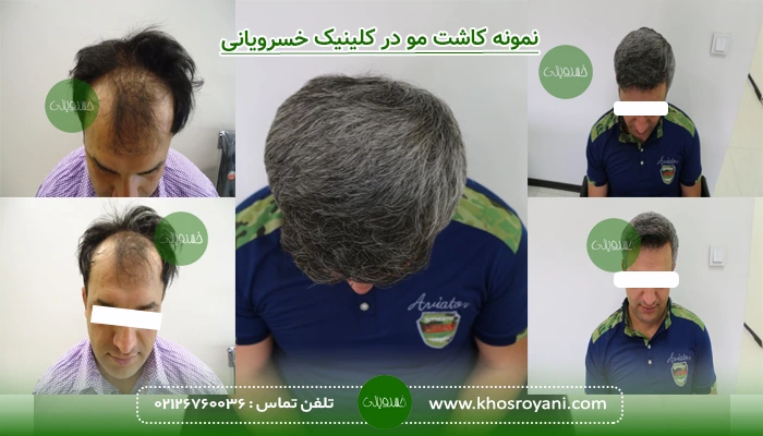 نتیجه کاشت مو