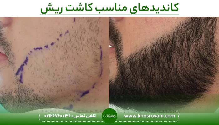 کاندیدهای مناسب کاشت ریش