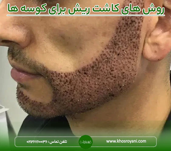 روش های کاشت ریش برای کوسه ها