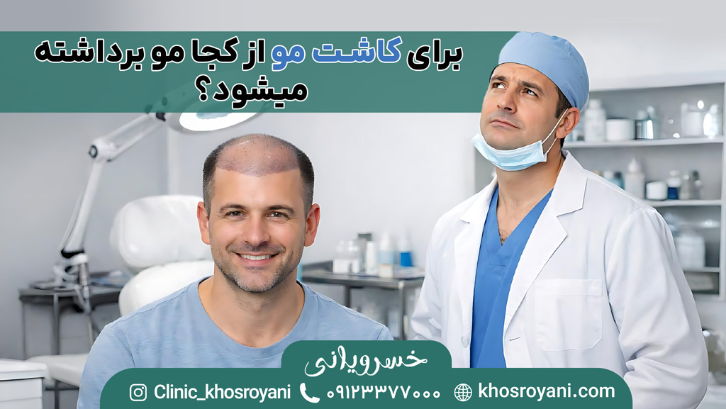 برای کاشت مو از کجا مو برداشته میشود؟