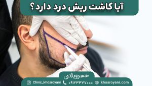 آیا کاشت ریش درد دارد؟