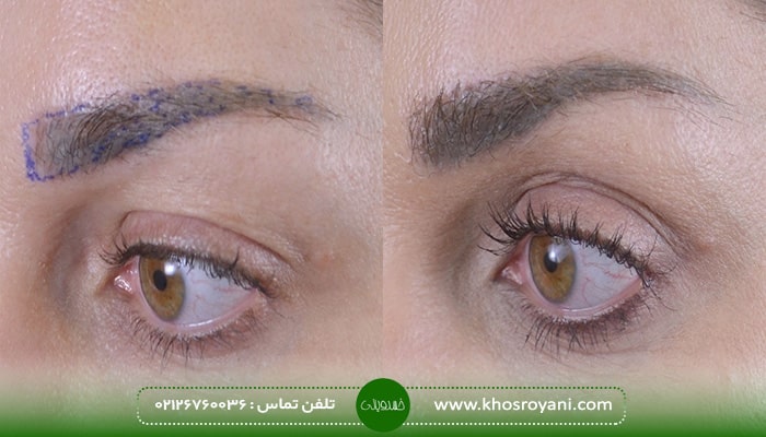 بهترین کلینیک کاشت ابرو سعادت آباد