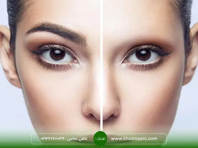 دلایل ریزش ابرو