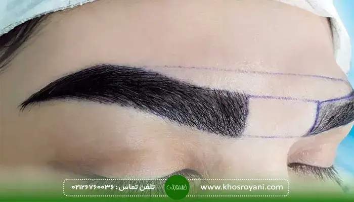 عوارض کاشت ابرو