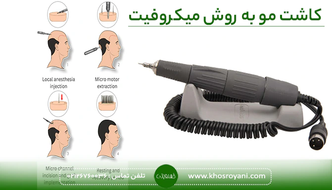 کاشت مو میکروفیت