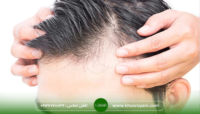 کاشت مو میکروگرافت برای چه افرادی مناسب نیست؟