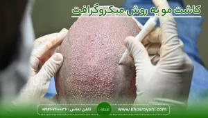 کاشت مو میکروگرافت