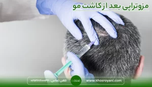 مزوتراپی بعد از کاشت مو