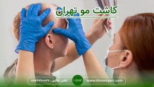 کاشت مو تهران