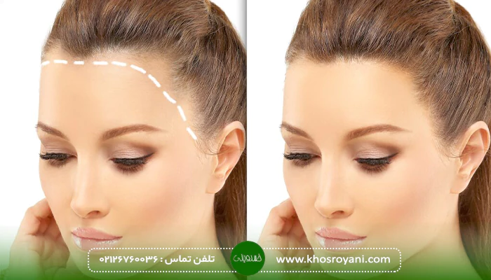 بهترین کاندیدای کاشت موی تضمین شده