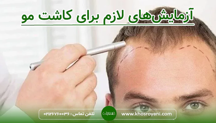 آزمایش‌های لازم برای کاشت مو