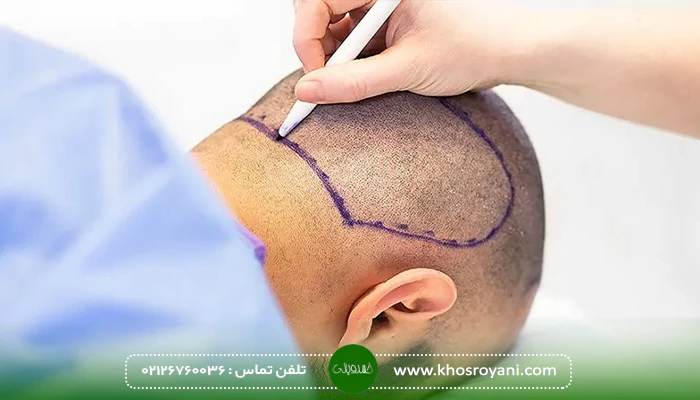 آیا گرما برای کاشت مو ضرر دارد؟