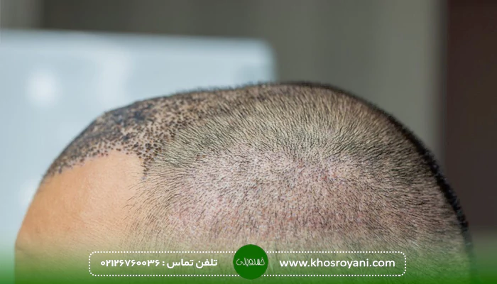 کاهش تورم بعد از کاشت مو با داروهای گیاهی