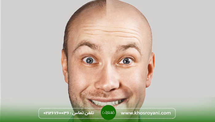 بهترین فصل کاشت مو 