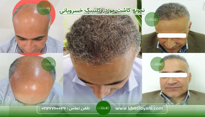 نمونه کاشت مو