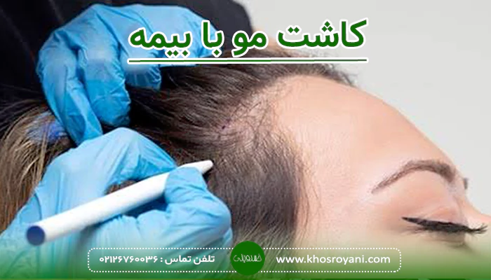 کاشت مو با بیمه