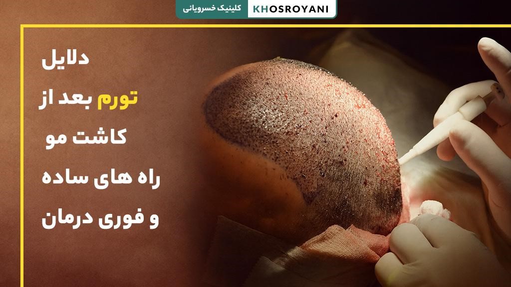 تورم بعد از کاشت مو