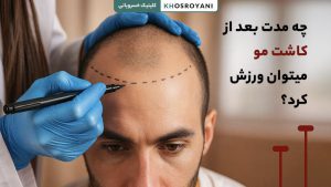 How long after hair transplantation can I exercise