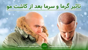 تاثیر گرما و سرما بعد از کاشت مو