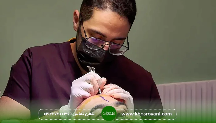 روش های کاشت مو