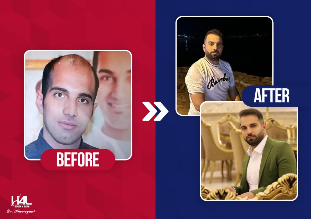 قبل و بعد کاشت مو در کلینیک خسرویانی