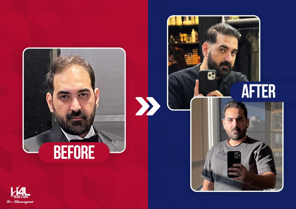 کاشت موی طبیعی توسط دکتر خسرویانی