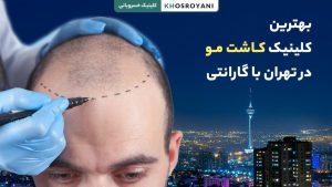 بهترین کلینیک کاشت مو در تهران