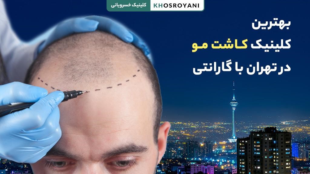 بهترین کلینیک کاشت مو در تهران