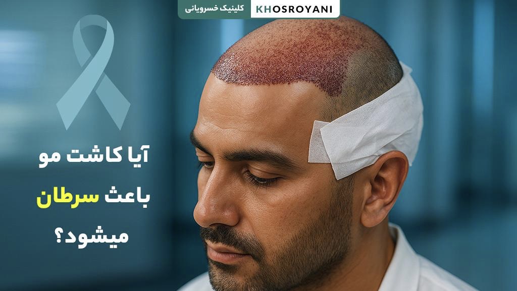 آیا کاشت مو باعث سرطان میشود؟ بررسی پزشکی + نکته‌های ایمنی
