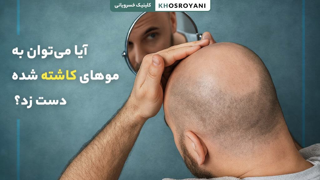 آیا می‌توان به موهای کاشته شده دست زد؟