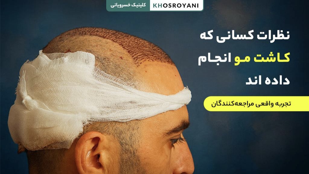 نظرات کسانی که کاشت مو انجام داده اند