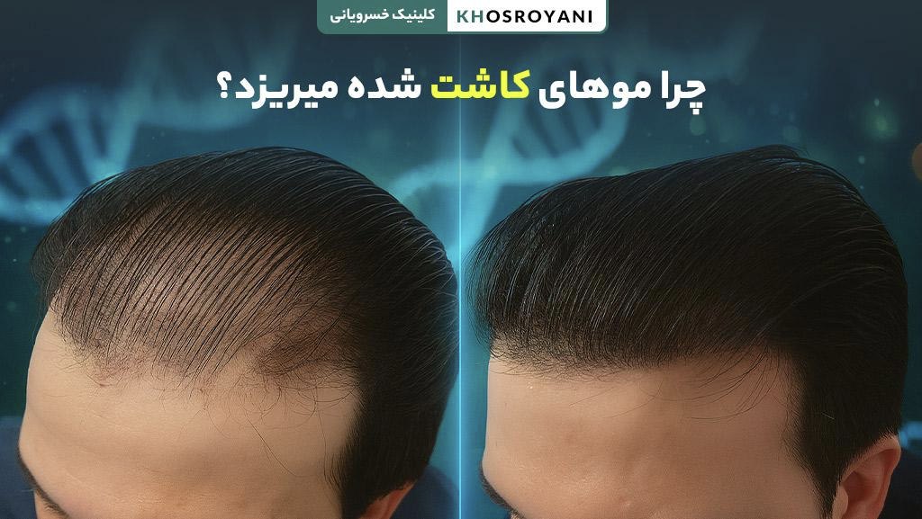 چرا موهای کاشت شده میریزد؟ (نکات مراقبتی بعد از کاشت مو)