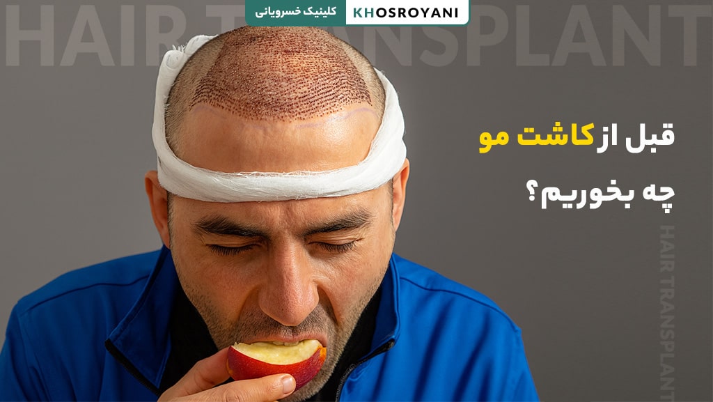 قبل از کاشت مو چه بخوریم